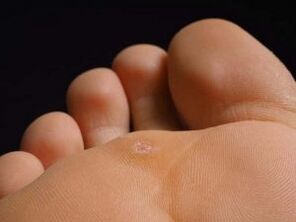 Reasons for plantar warts
