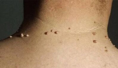 The causes of papillomas on the human body