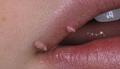 Types of papilloma in people