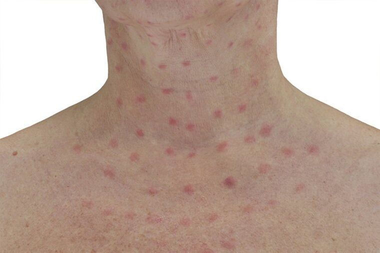 Skin after electrocoagulation