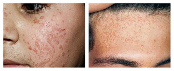 Flat warts on the face