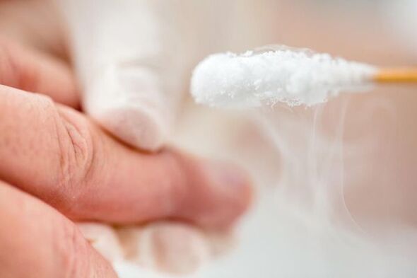 War -Treatment with liquid nitrogen