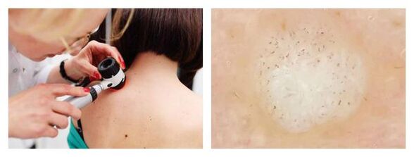 Wart dermatoscopy