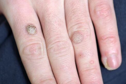 Warts on the hand
