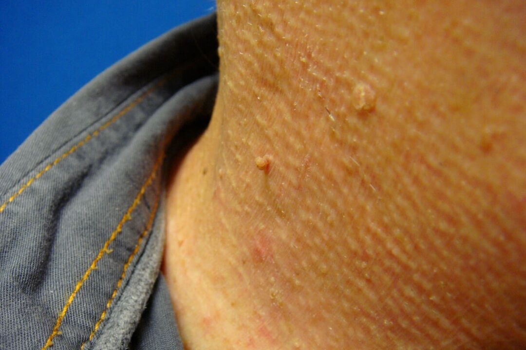Papillomas on the neck of a person