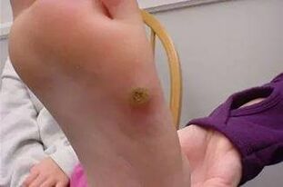 Warts