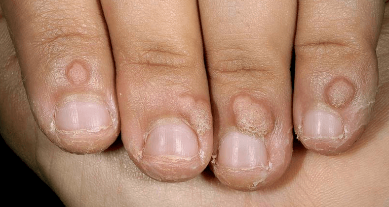 Warts