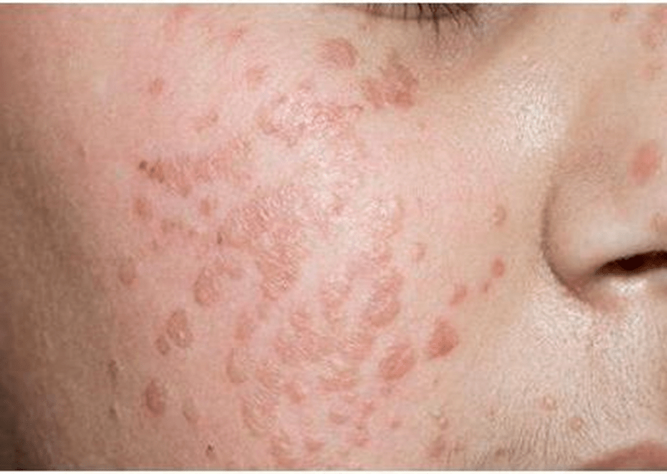 Youthful warts