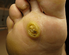 Papillomas