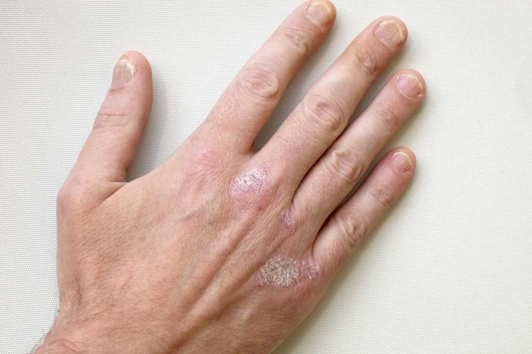 treatment of psoriasis on the hands of a man with cream Keramin
